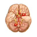 brain aneurysm