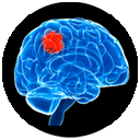 brain tumour