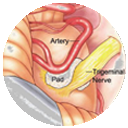 Trigeminal neuralgia