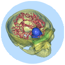 Skull base tumors